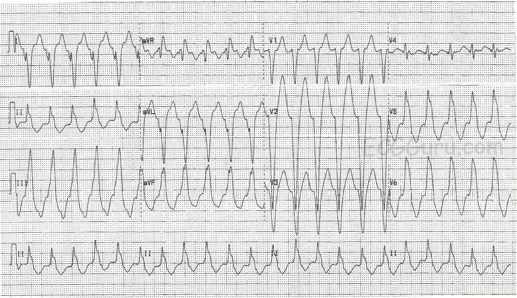 Right Ventricular Outflow Tract Tachycardia (RVOT) ECG Guru